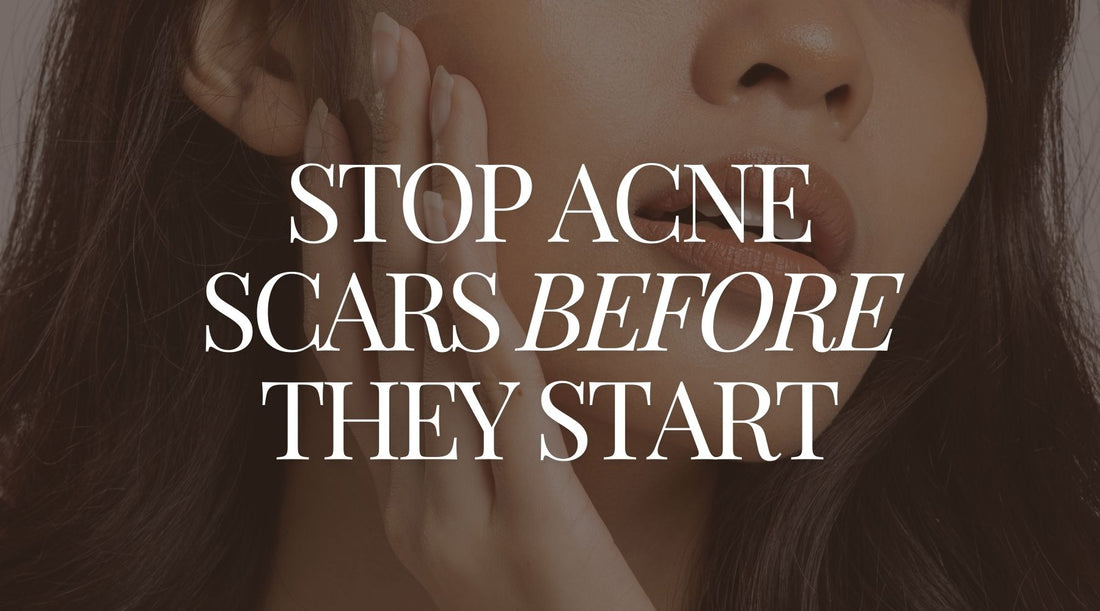 Close-up of a woman with clear skin and the text 'Stop Acne Scars Before They Start,' promoting natural remedies and lifestyle tips to prevent acne scars and reduce inflammation.