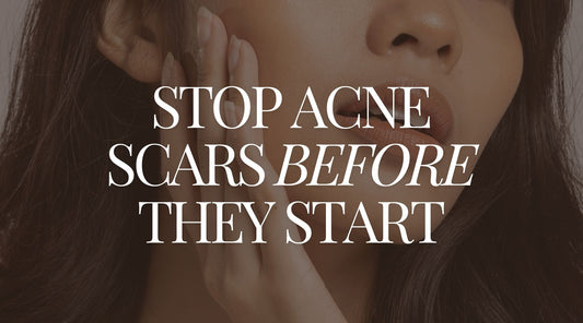 Close-up of a woman with clear skin and the text 'Stop Acne Scars Before They Start,' promoting natural remedies and lifestyle tips to prevent acne scars and reduce inflammation.